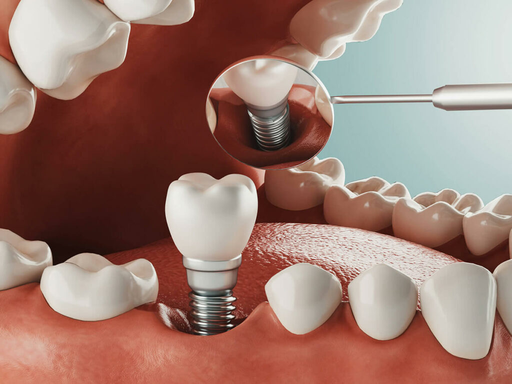 Graphic of a dental implant being screwed into the socket