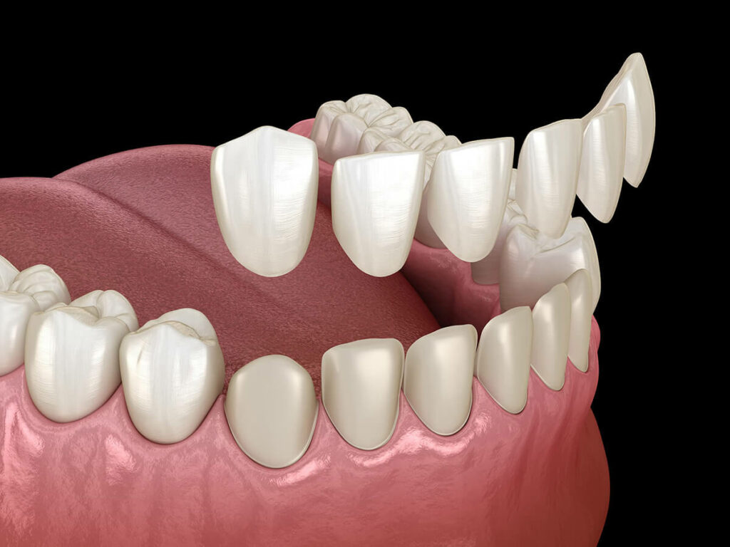 Graphic of porcelain veneers being placed over teeth.