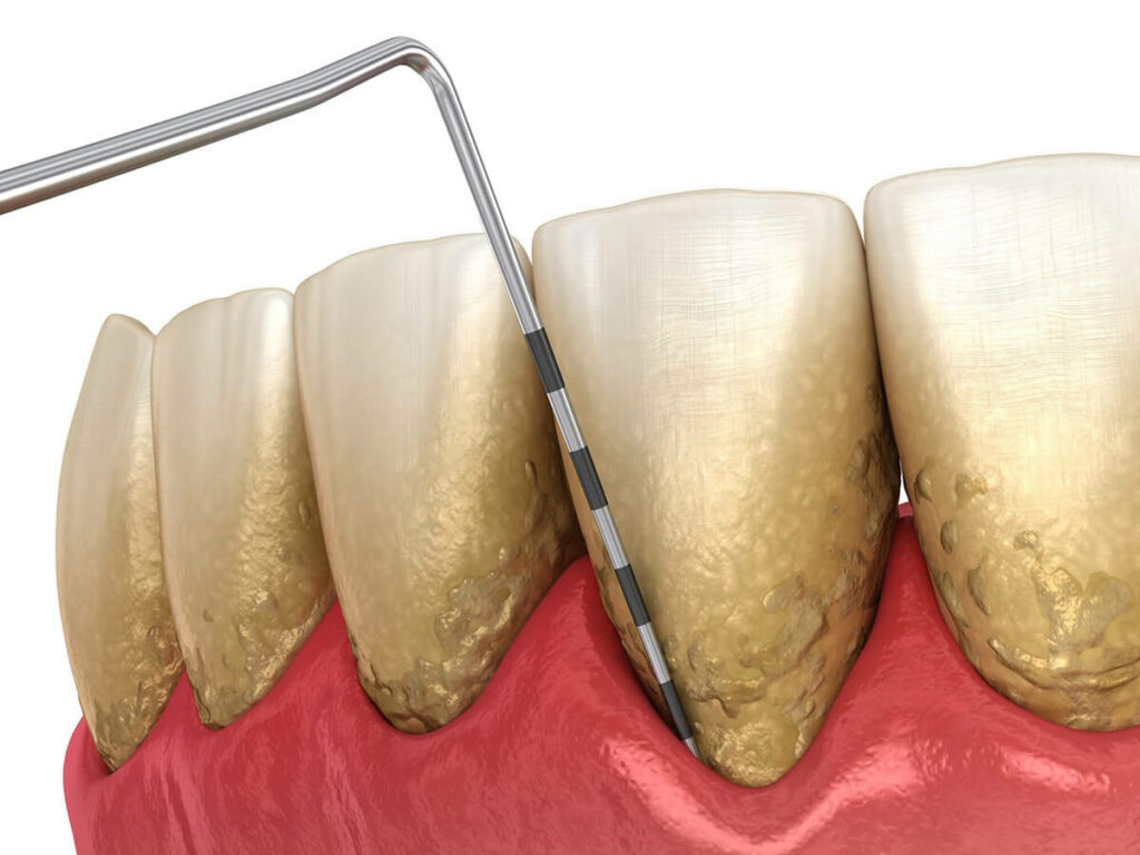 Periodontal disease on a row of teeth