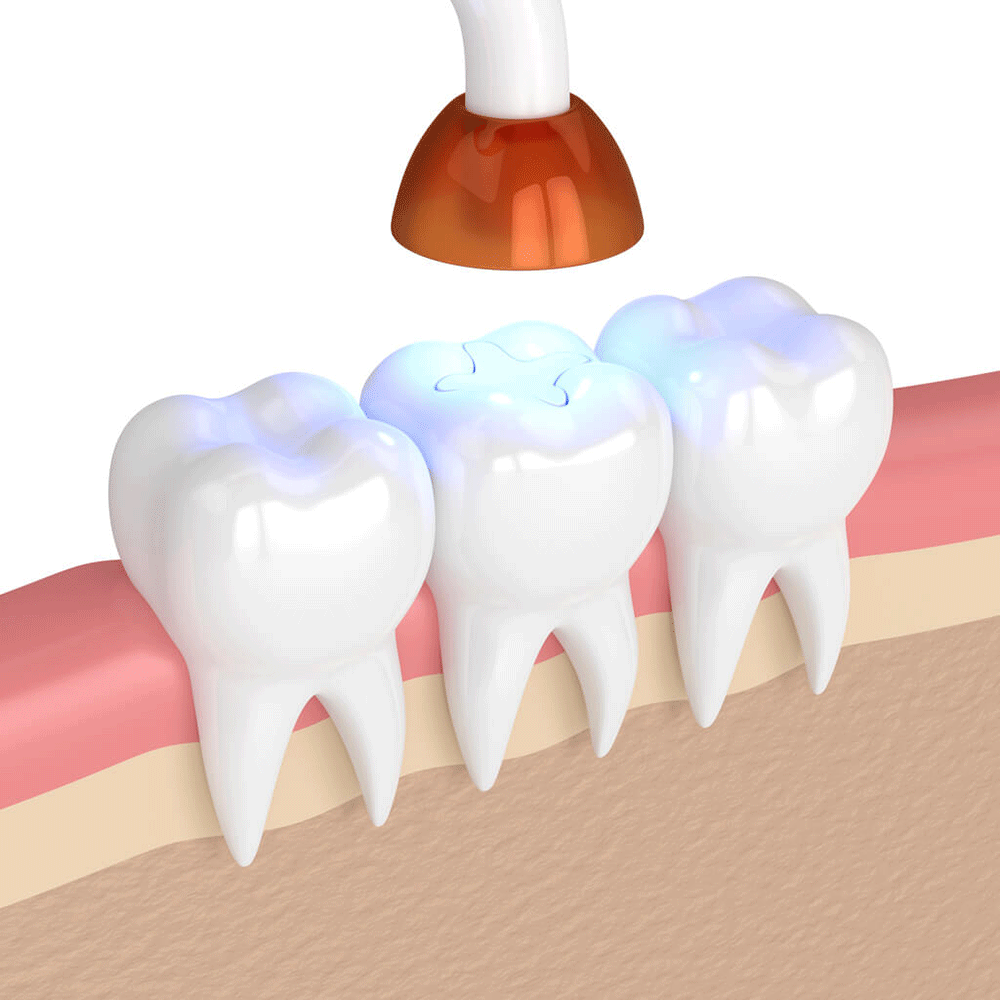 Graphic of a filling be set in the tooth