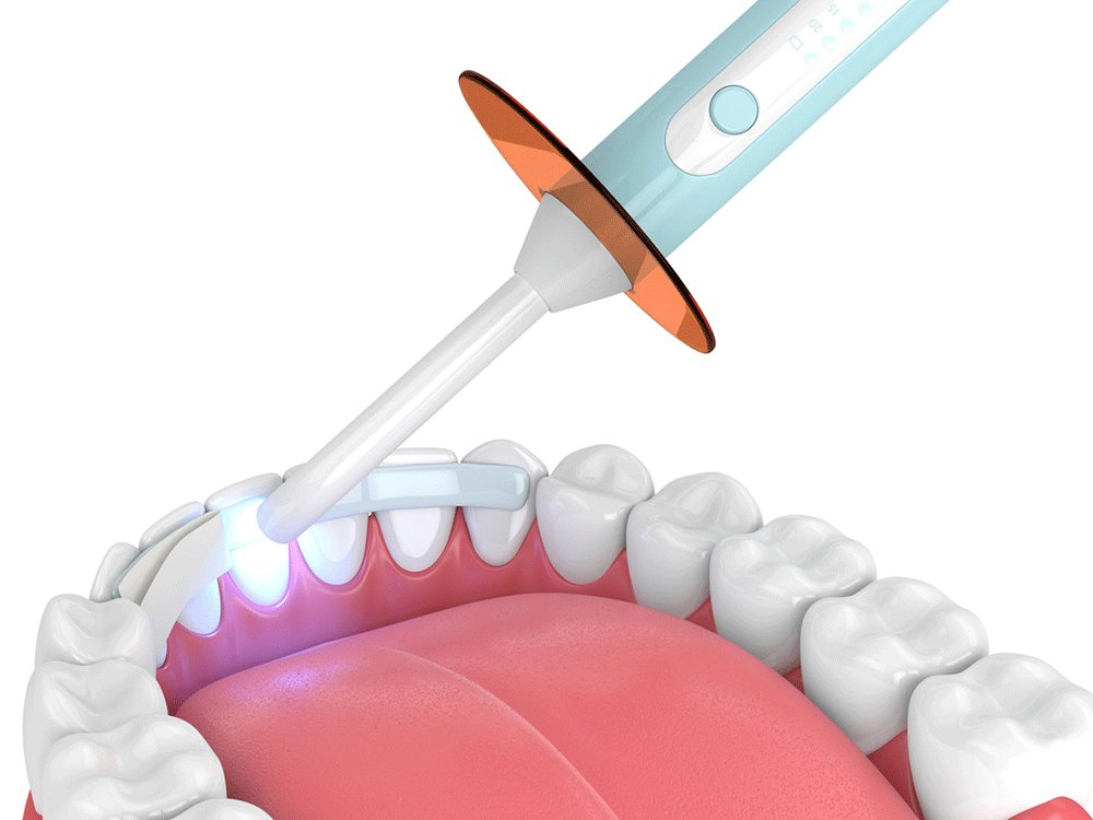 Graphic of a dental bonding procedure