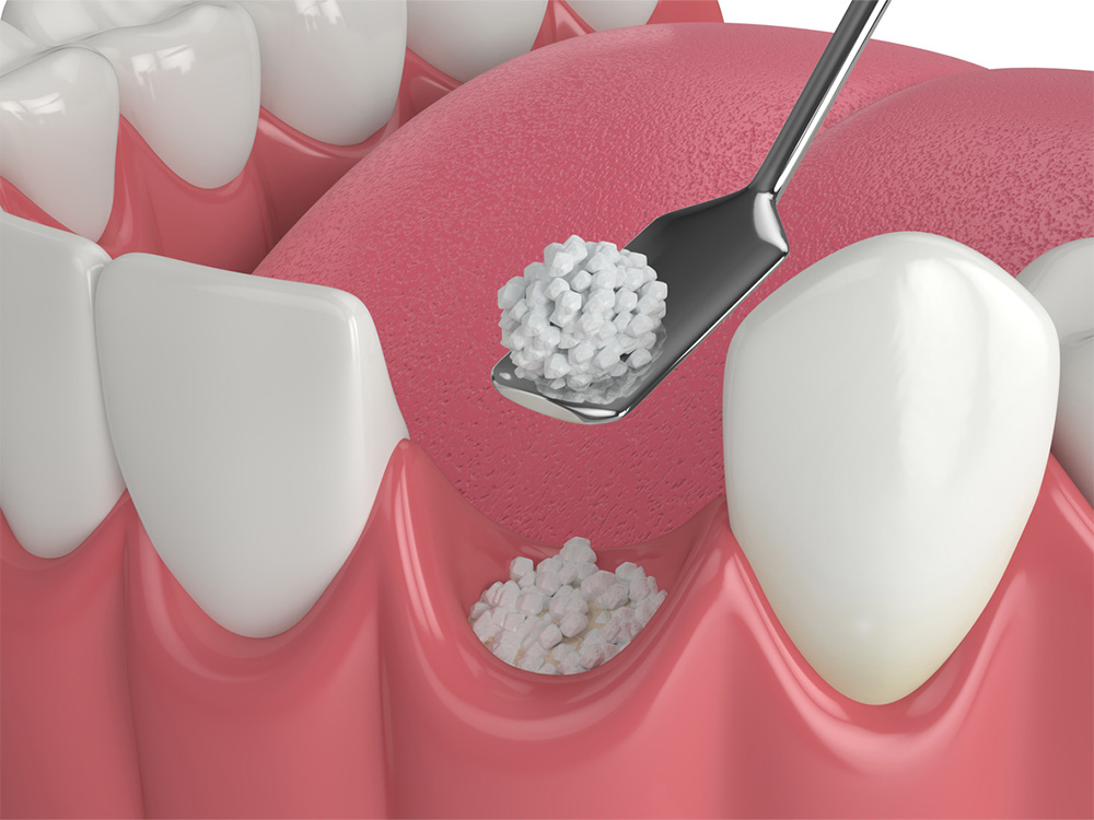 Graphic of a dental bone grafting procedure.