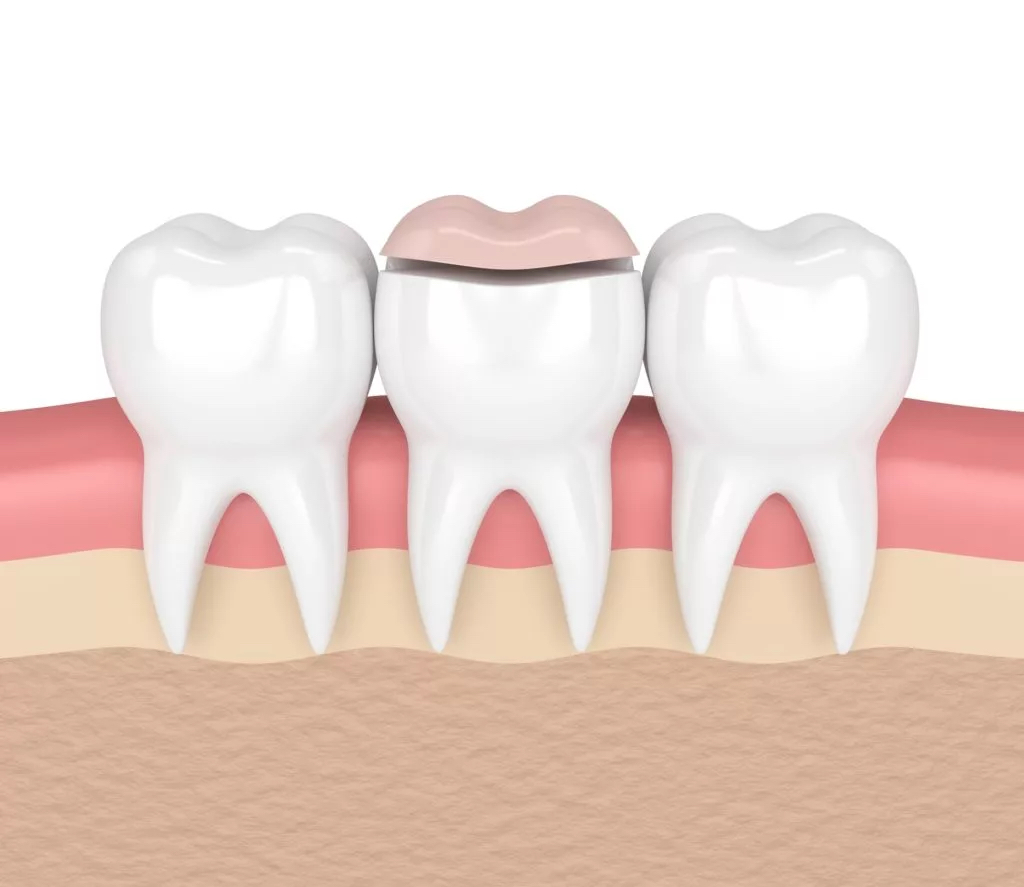 Graphic of a dental inlay being placed on top of a tooth