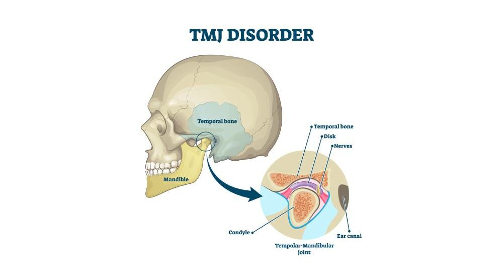 TMJ disorder vector illustration. Labeled jaw condition educational scheme. Diagram with joint clicking and pain anatomical structure and explanation. TMJD syndrome with mandibular movement closeup.