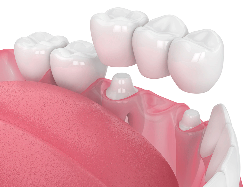 Dental bridge being placed in the mouth