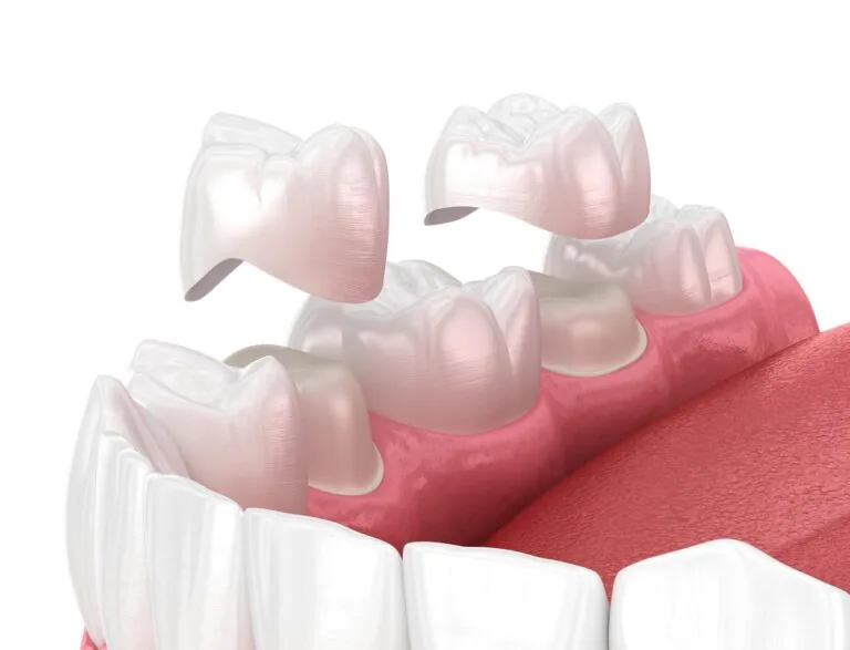 Close-up view of dental crowns being positioned over prepared teeth inside a mouth, with visible gums and tongue. Illustrates the crown placement process in restorative dentistry.